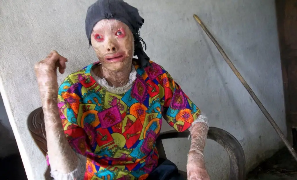 Milagros, la mujer pez en Cuba que no se atreve a salir a la calle