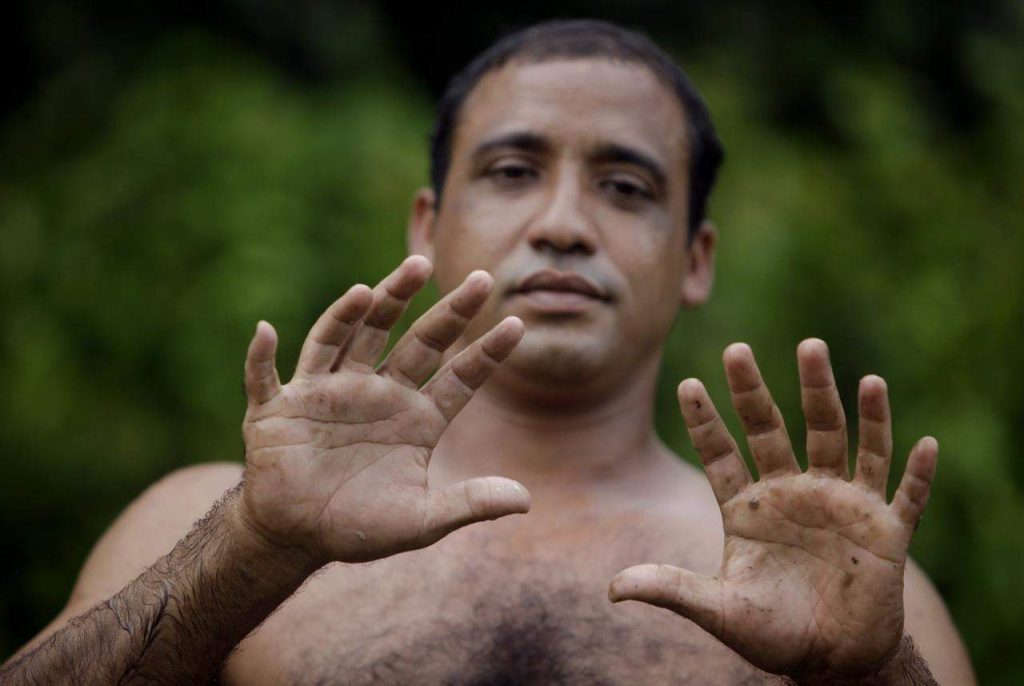 Yoandri, un cubano con 24 dedos