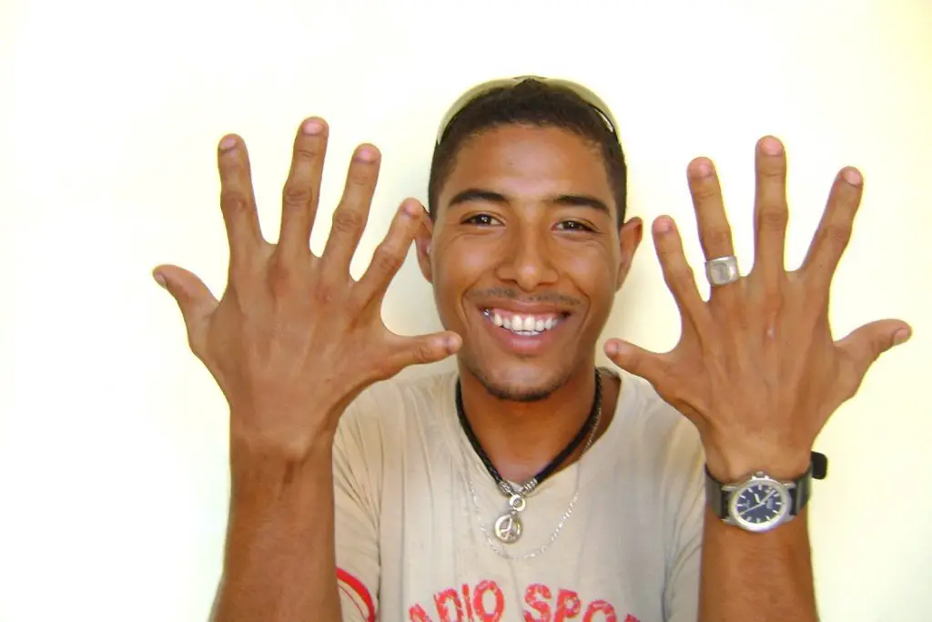 Leonardo, un joven cubano con 24 dedos