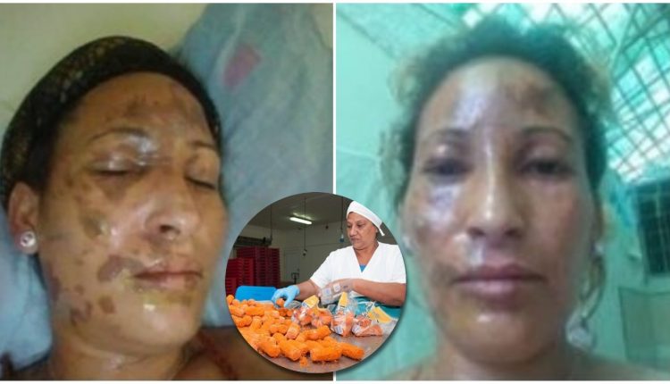Así quedó el rostro de esta cubana por una croquetas explosivas en su cocina
